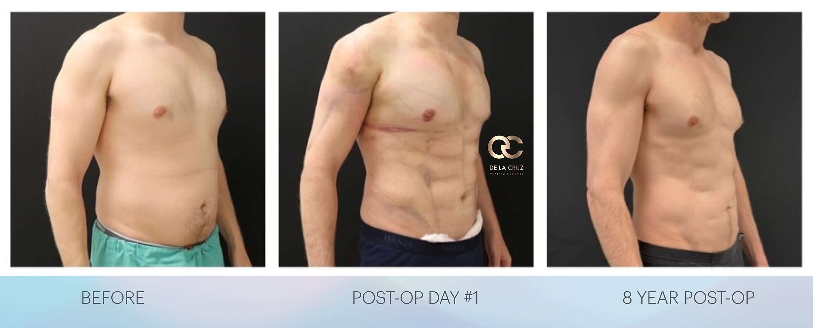 Before and Afer High-definition Liposuction in Men: before, day one, and eight years.  Performed by Double-board certified plastic surgeon Dr. Emmanuel De La Cruz
