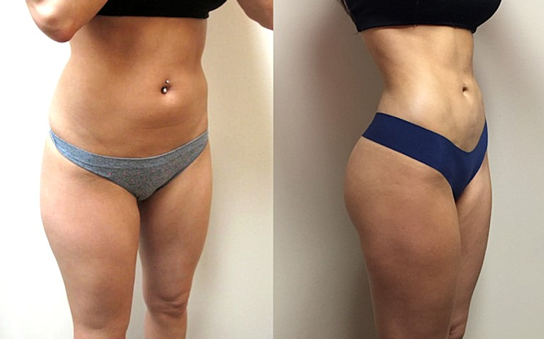 4D VASER Hi-Definition Liposuction in Houston, Texas