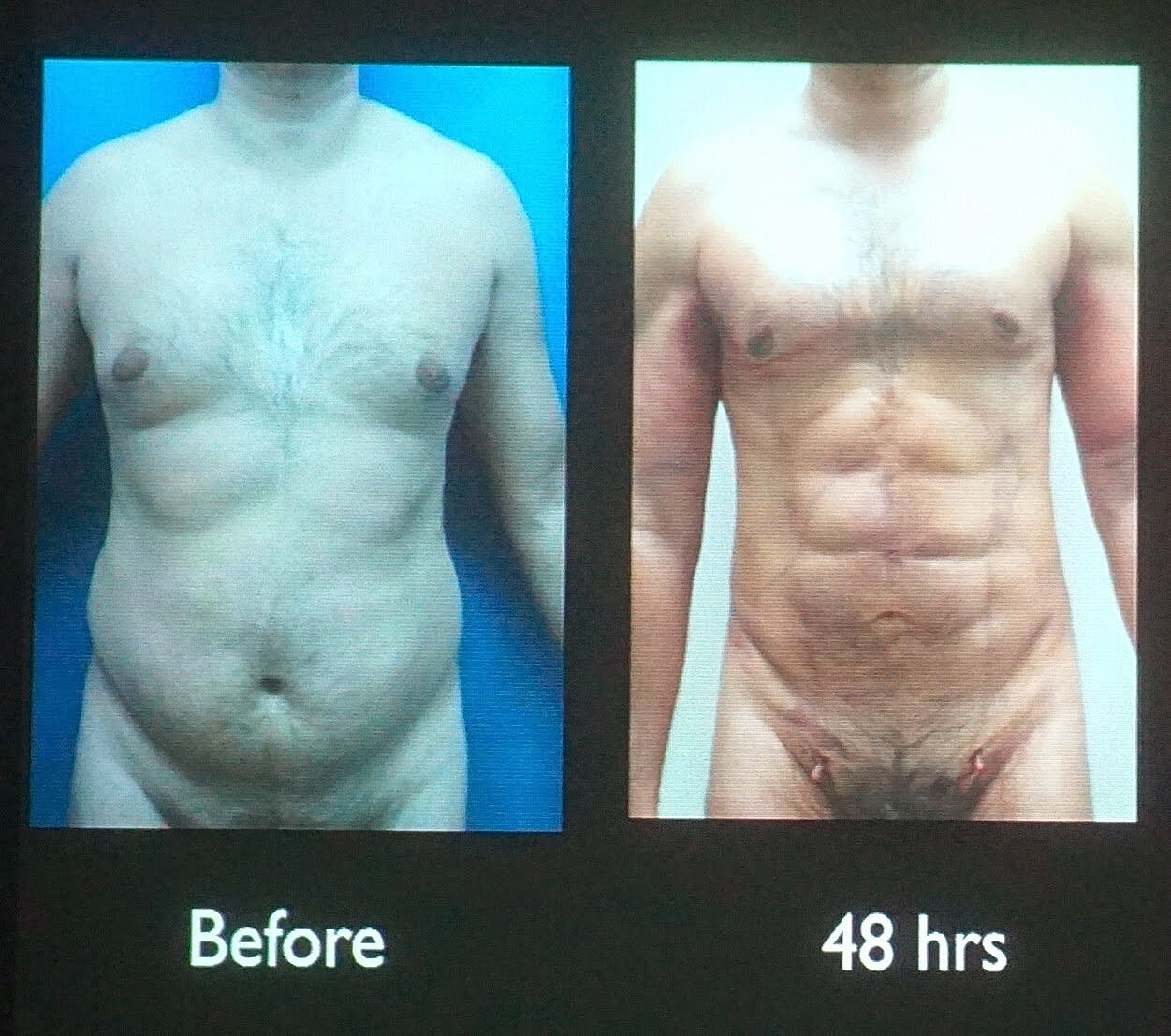 4D VASER High Definition Liposuction with Dr. Alfredo Hoyos and Dr. De La Cruz