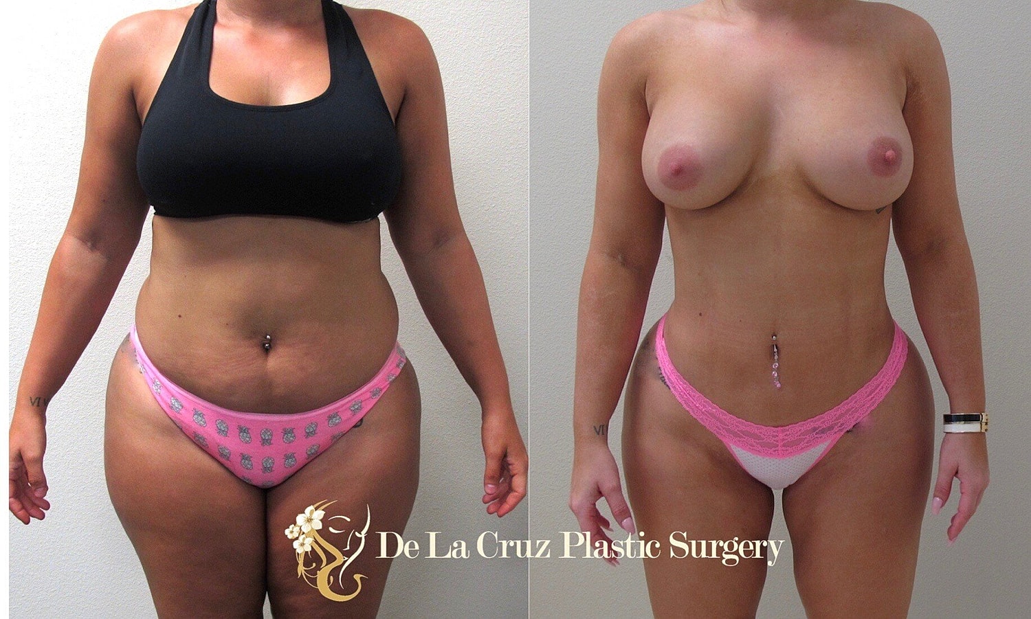 Benefits of VASER Liposuction over Traditional Tumescent Liposuction