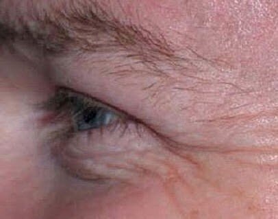 BOTOX Injection for the Wrinkles Around Your Eyes (Crow’s Feet)