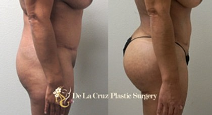 Brazilian Butt Lift: One of the Fastest Growing Plastic Surgery Procedures in America