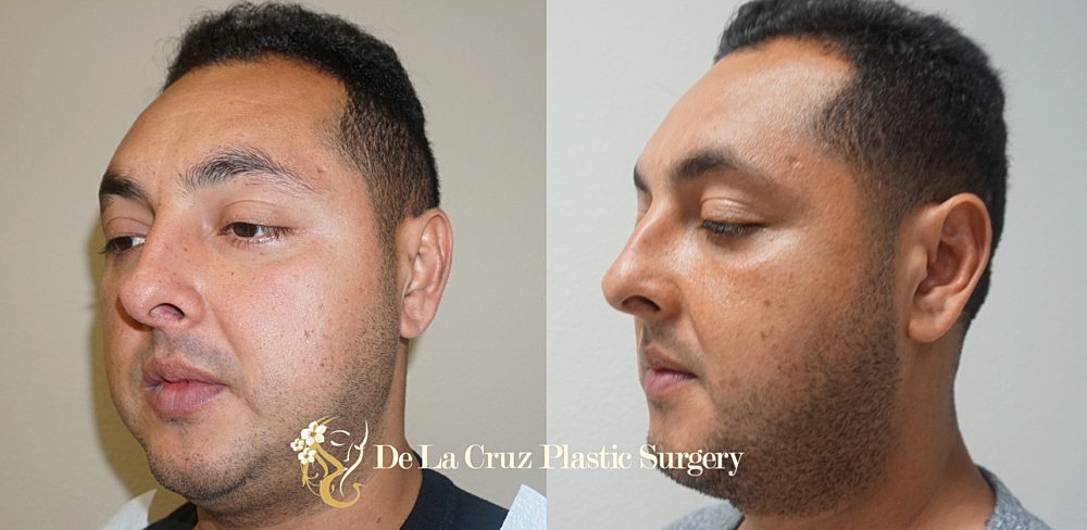 Buccal Fat Removal | Bichectomia in Houston, Texas