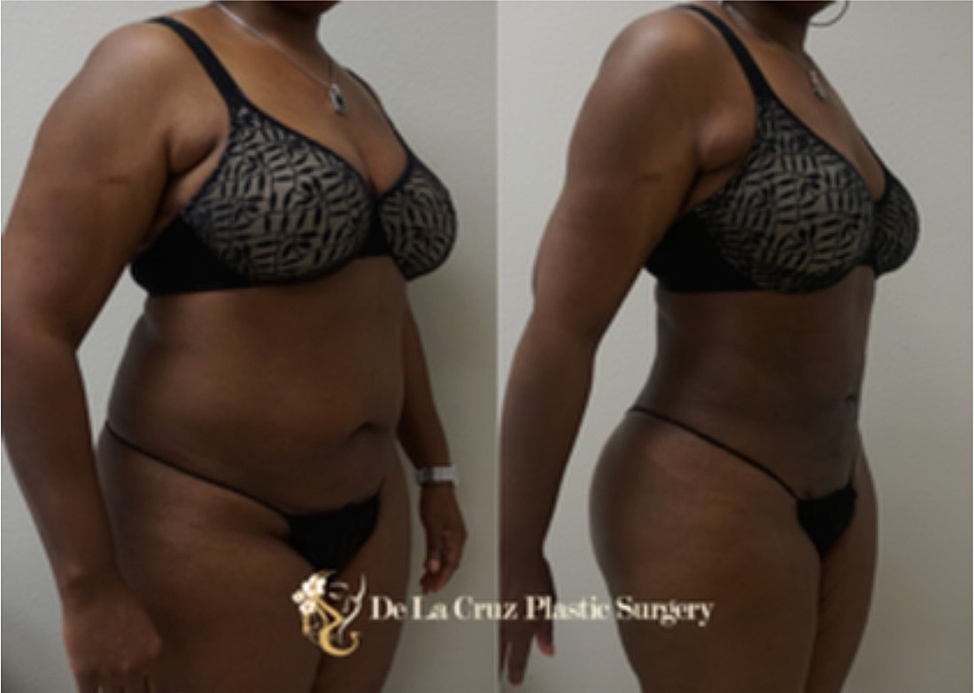 Dramatic Results with Large Volume 4D VASER Liposuction