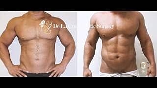 Liposuction Houston - 4D VASER High-Definition Liposuction