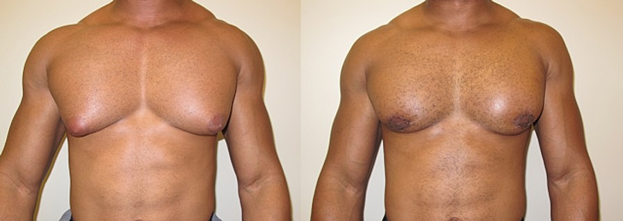 Male Breast Reduction for Gynecomastia