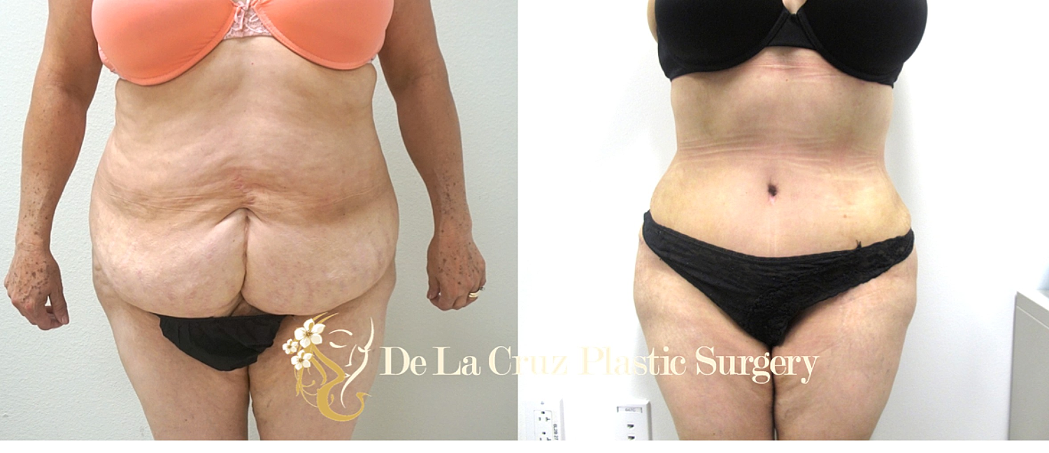 Post-Operative Abdominoplasty Complications