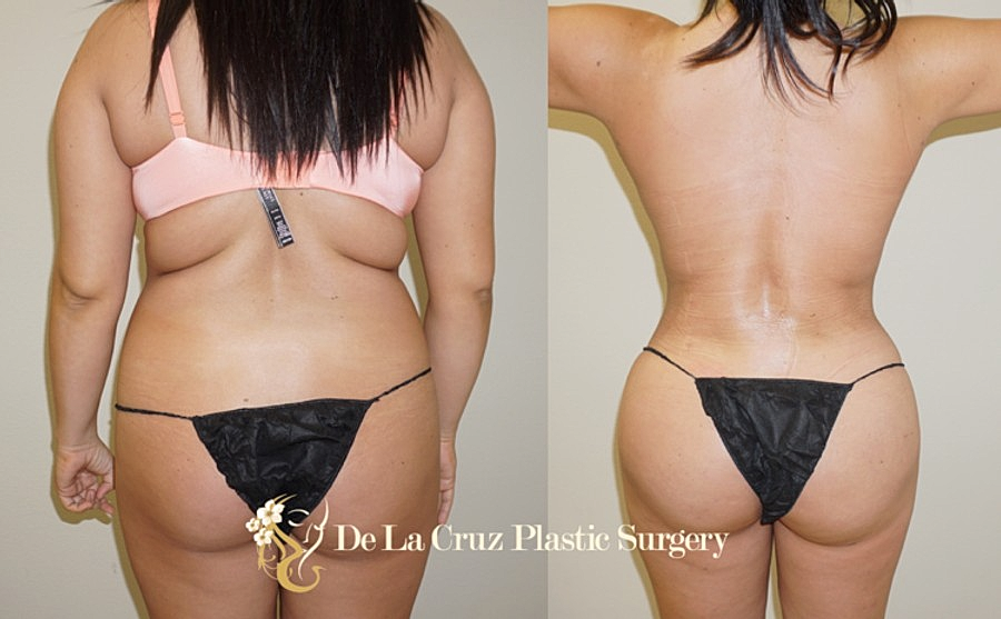 Post-Operative Care to Speed up Brazilian Butt Lift Recovery