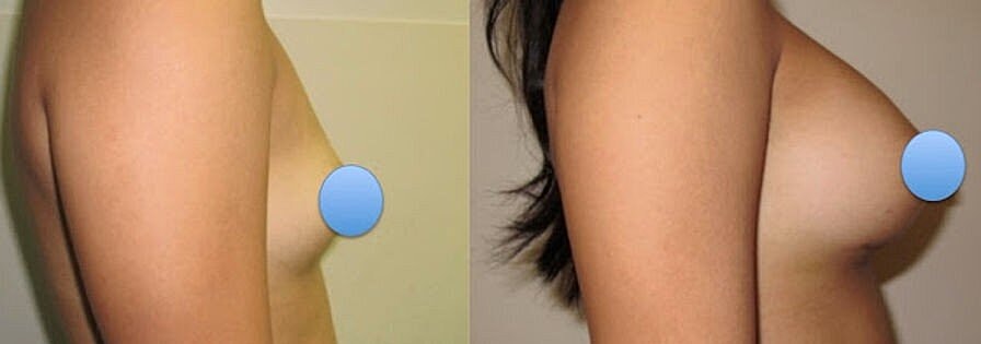 Small Risk of Lymphoma Associated with Breast Implants