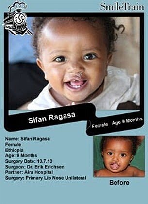 Smile Train & Operation Smile of the Month