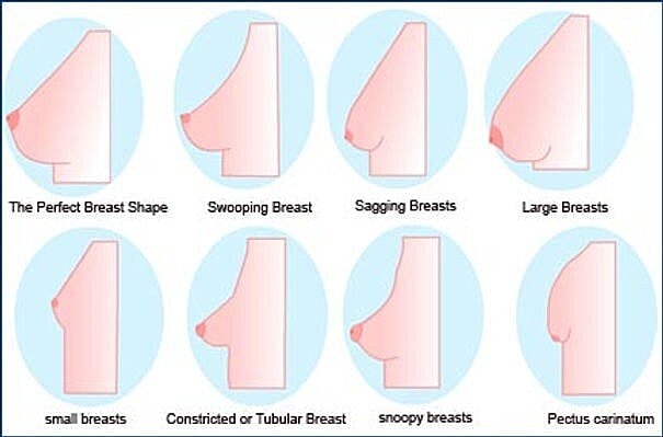 The Perfect Breast | Houston Breast Augmentation