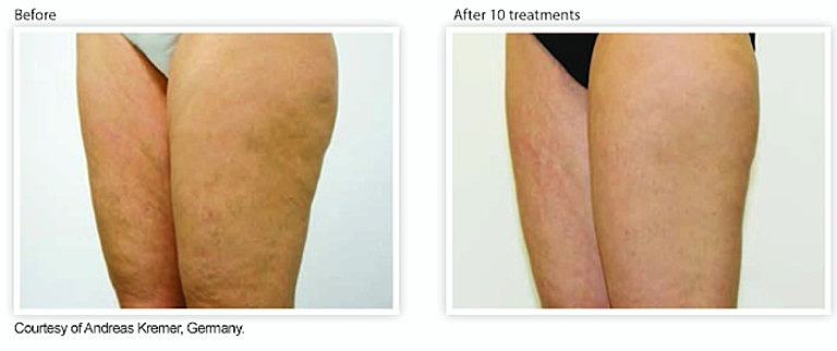 Venous Freeze in The Woodlands