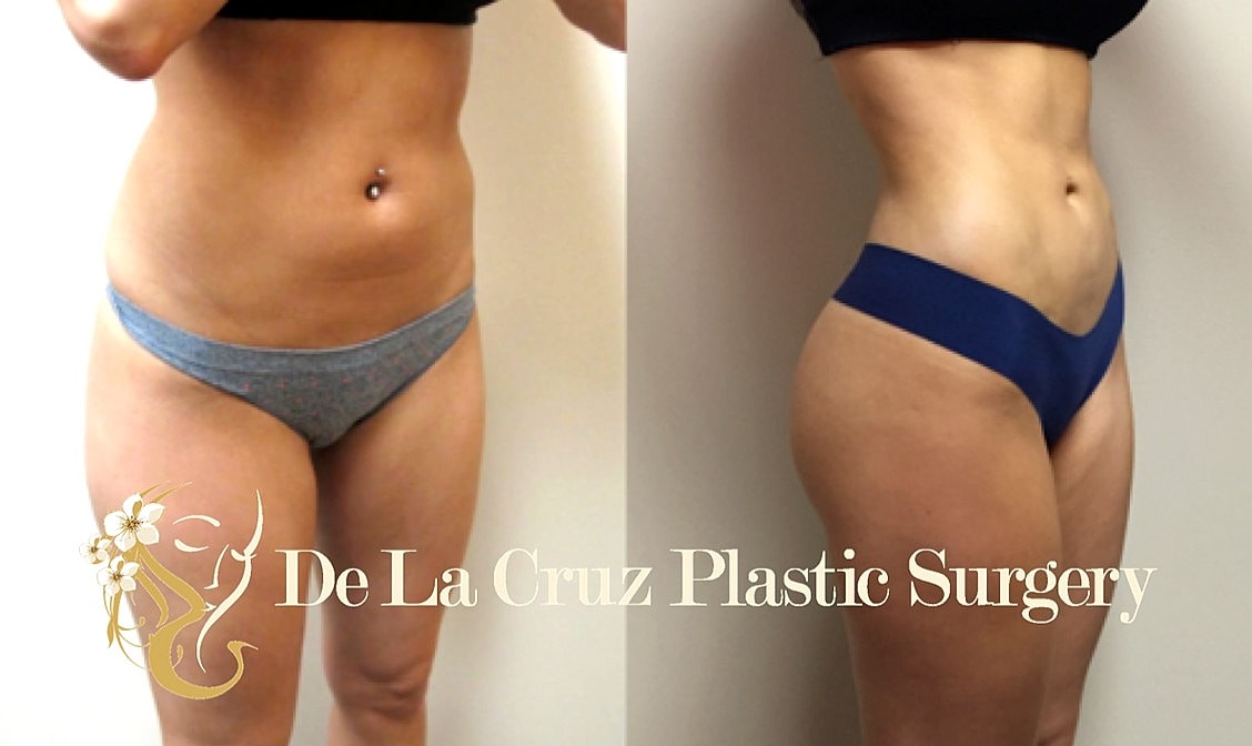 Body transformation before and after plastic surgery