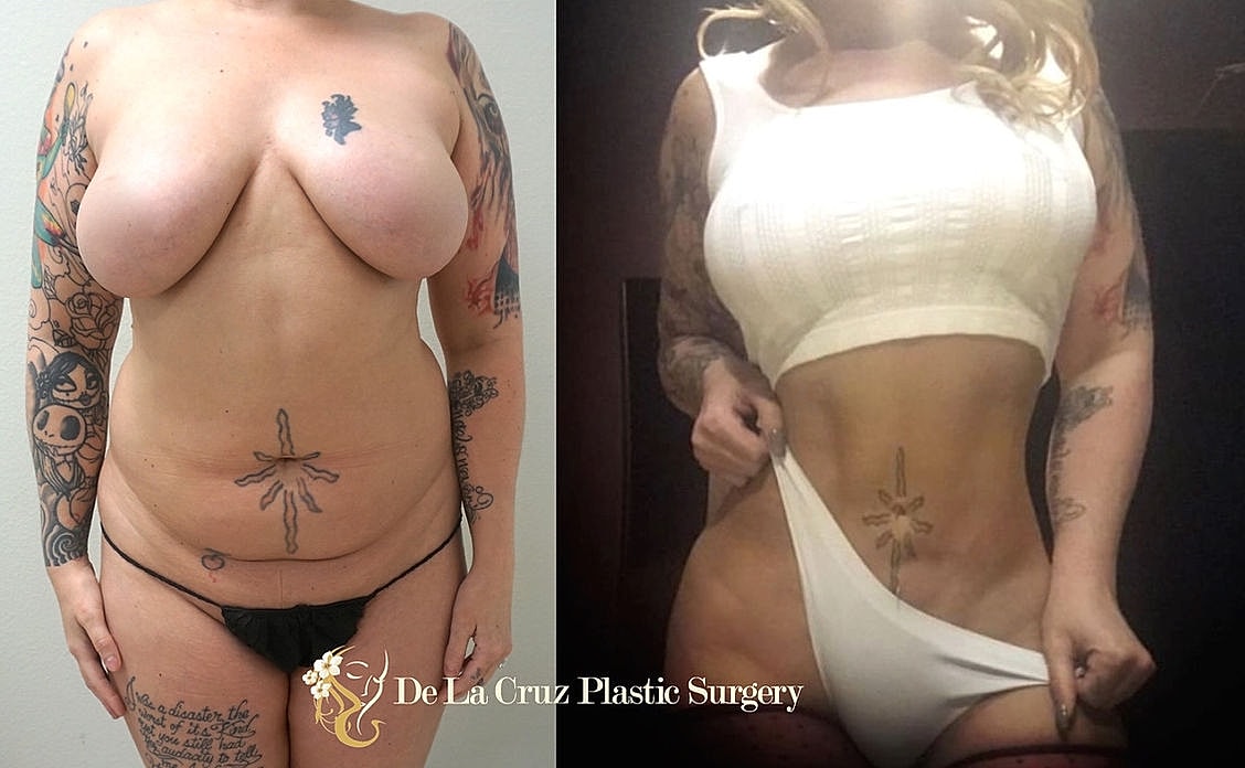 Before and after plastic surgery transformation.