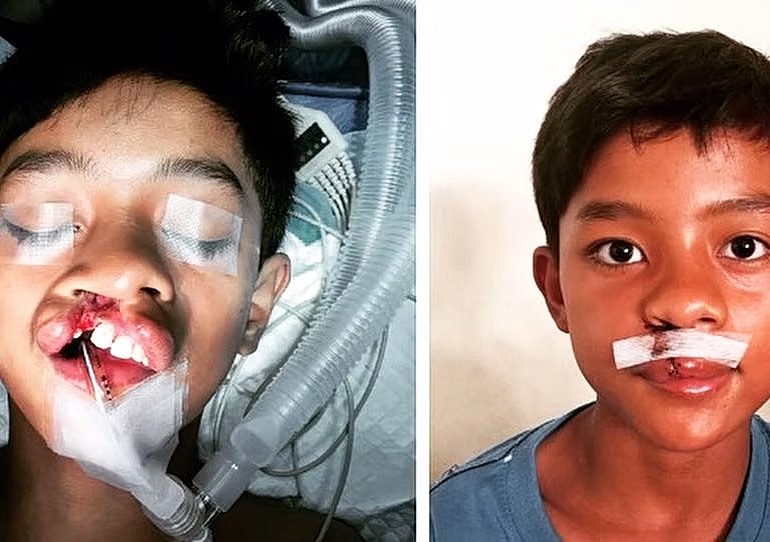Post-surgery recovery of a child's facial injury.