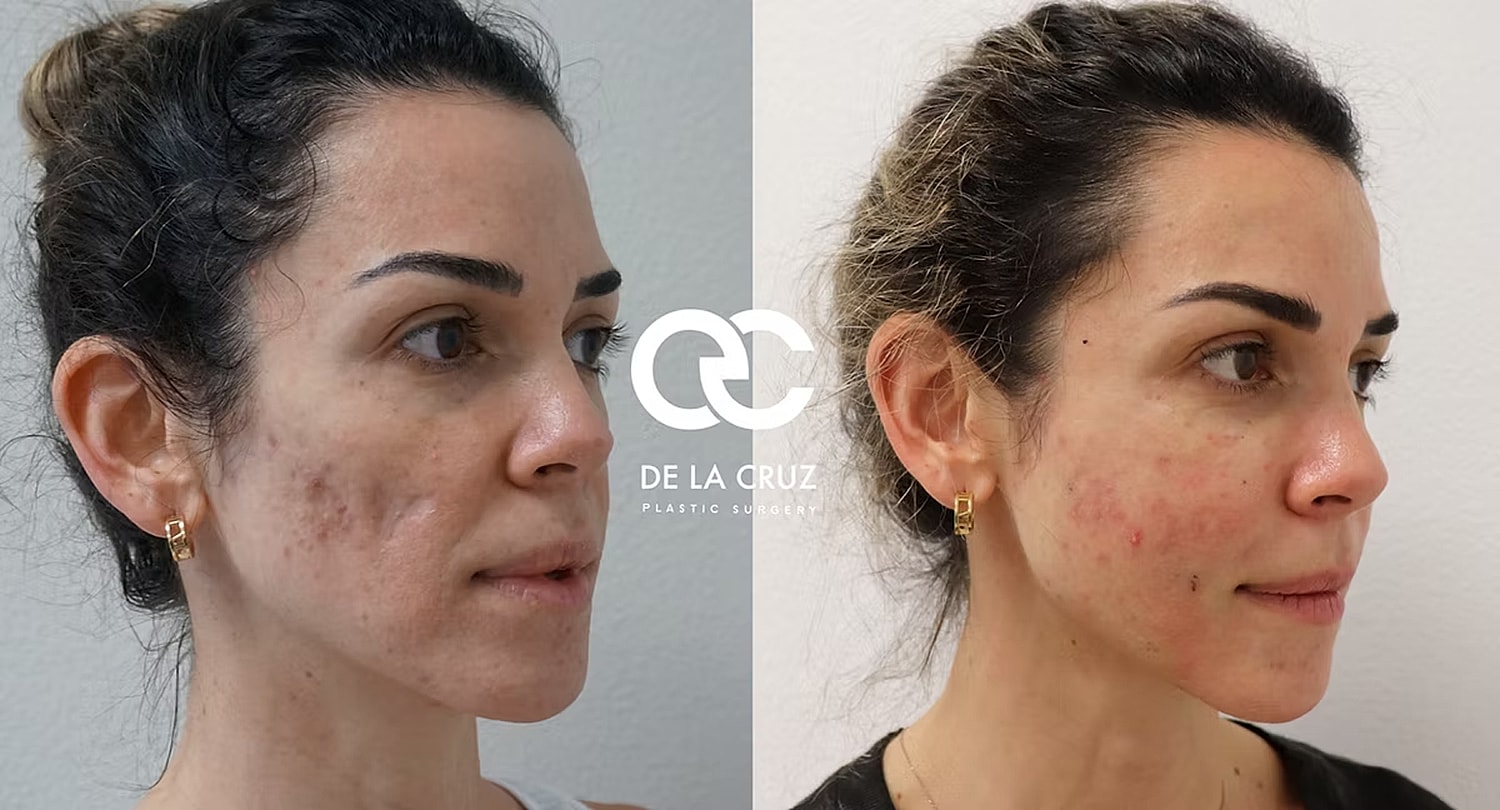 Before and after skincare treatment comparison.