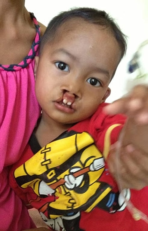 Child with facial difference reaching out.