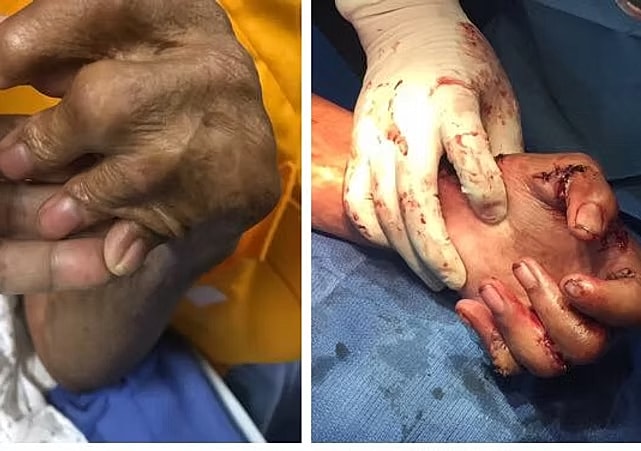 Before and after hand surgery comparison.