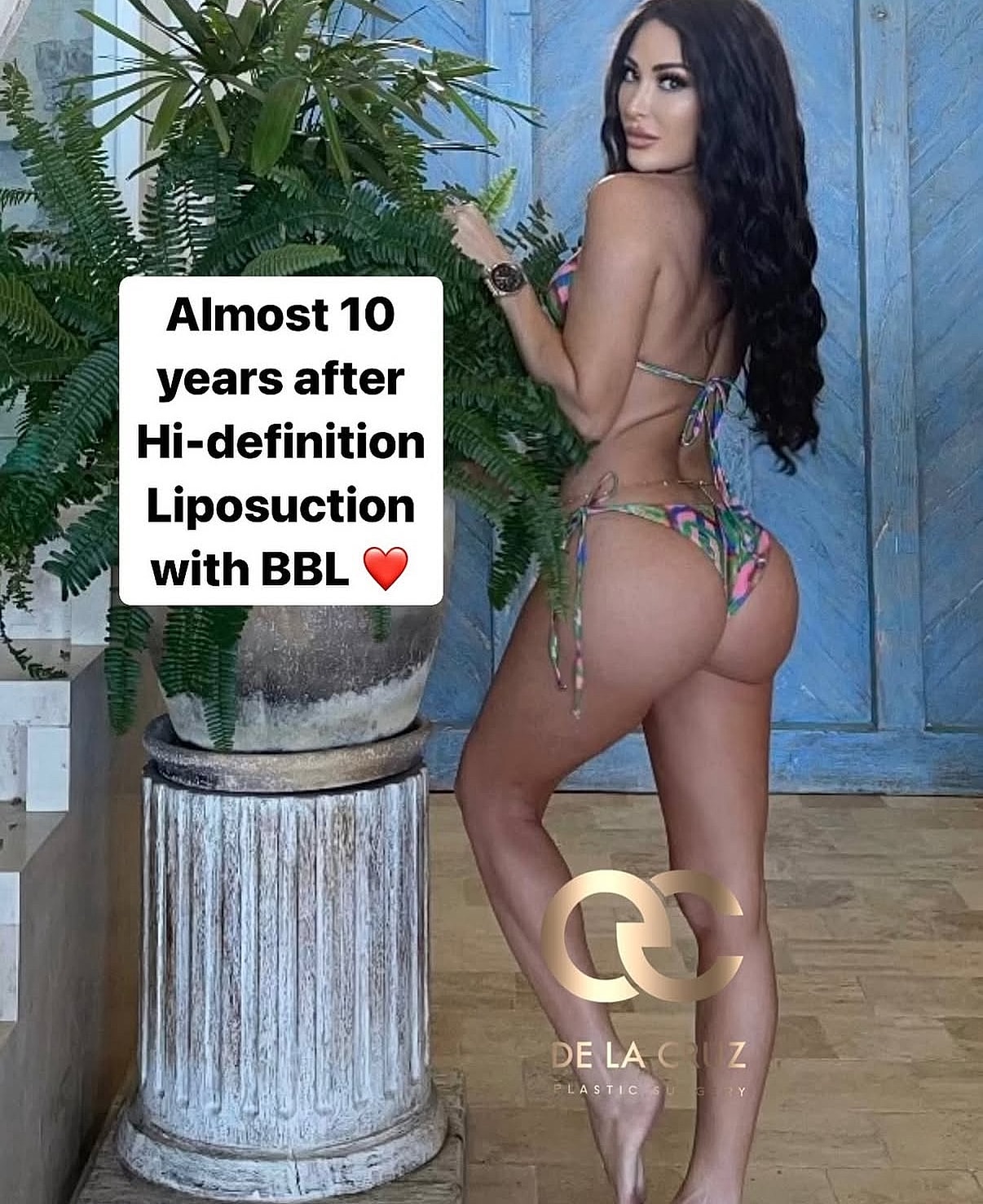 Model posing after liposuction and BBL procedure.