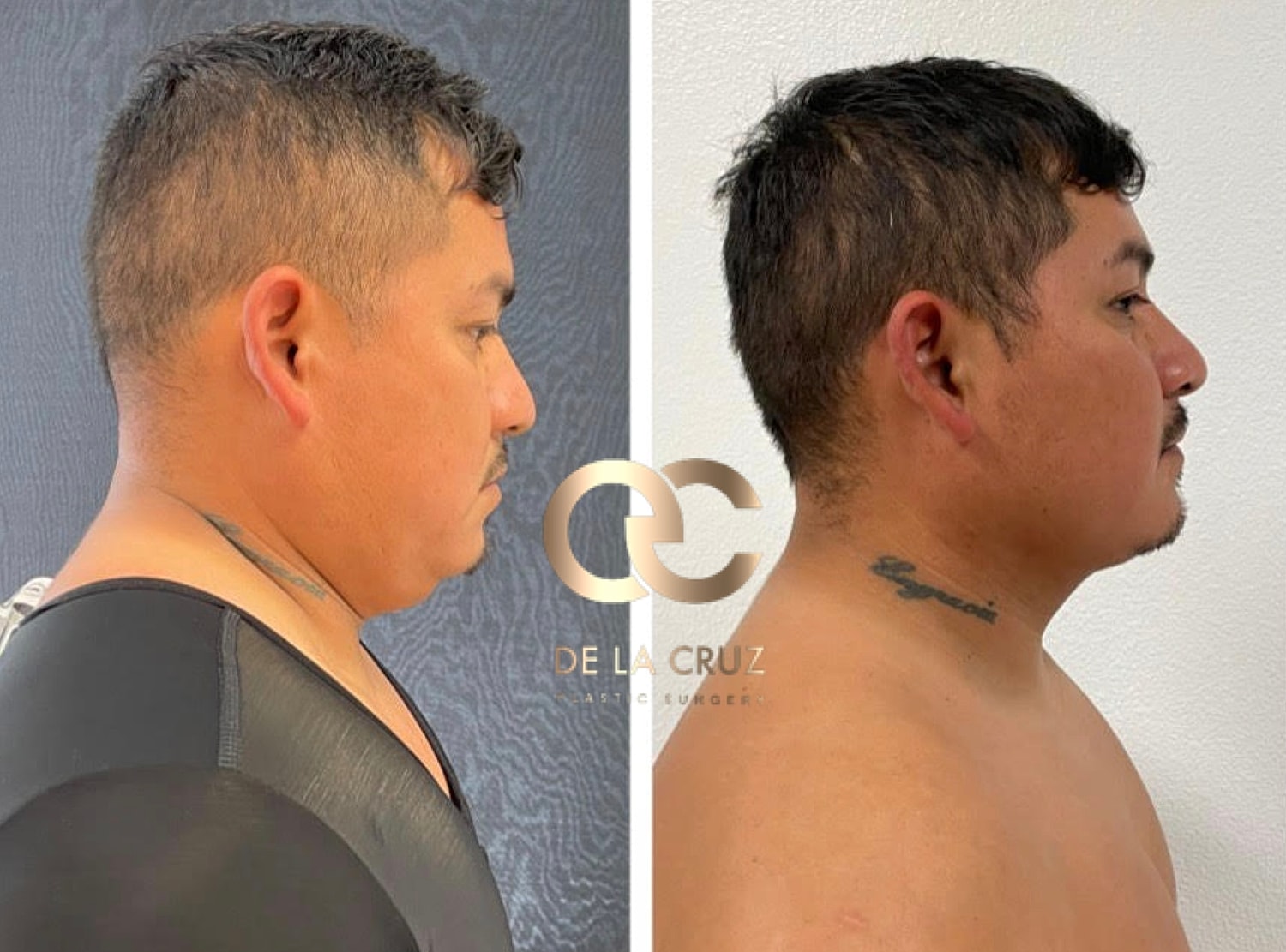 Before and after neck liposuction