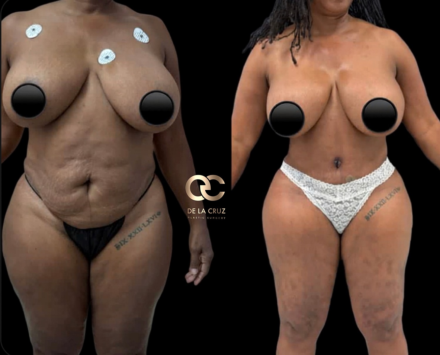 Before and after Lipedema Surgery