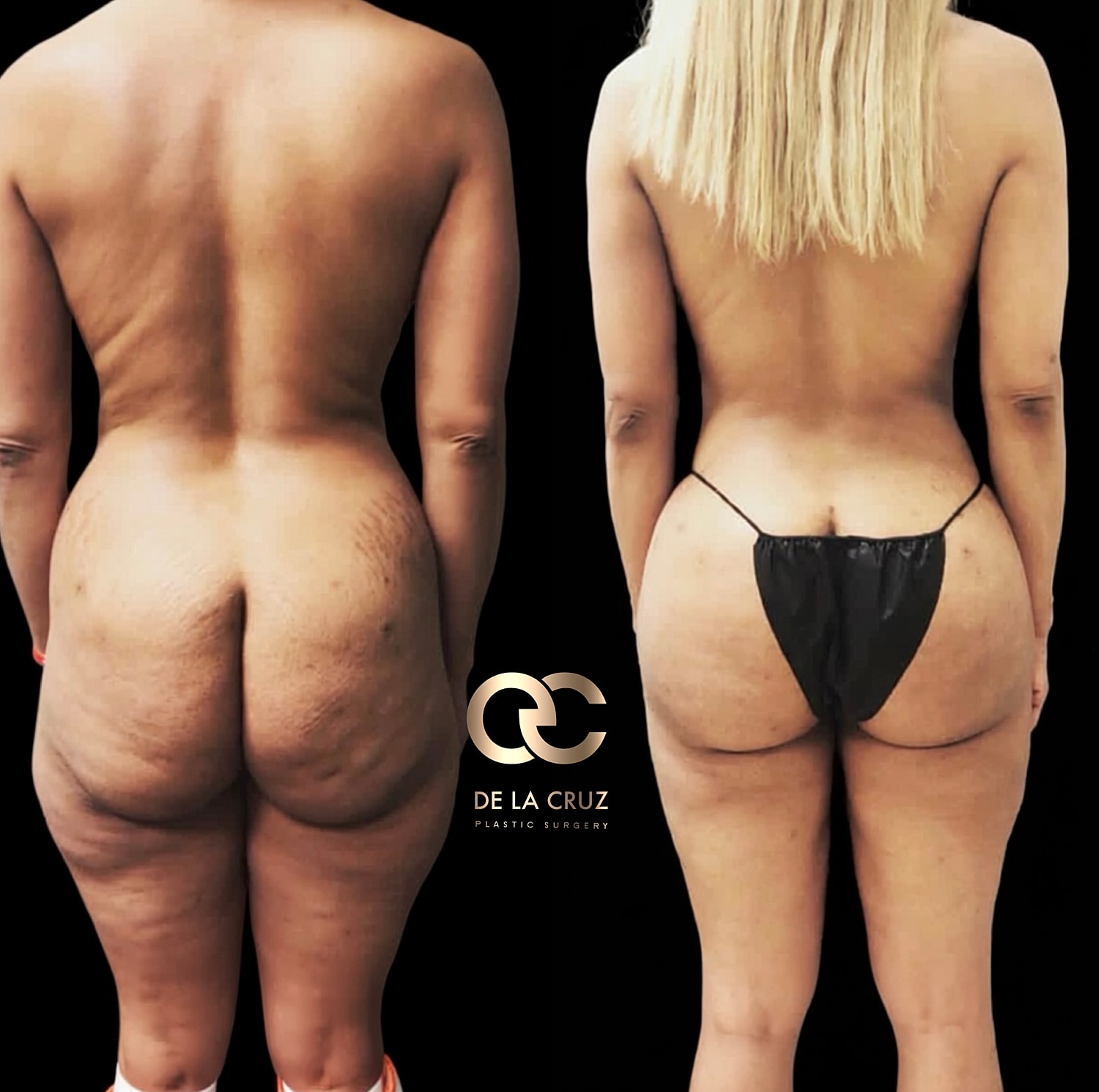 Before and after plastic surgery transformation comparison.