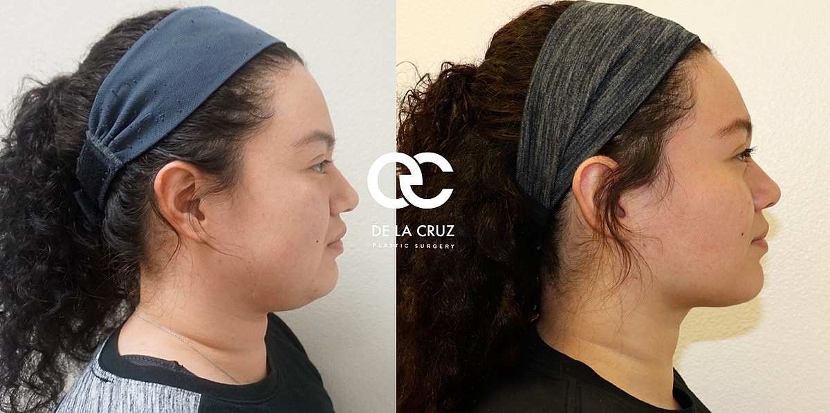 Profile comparison before and after treatment.