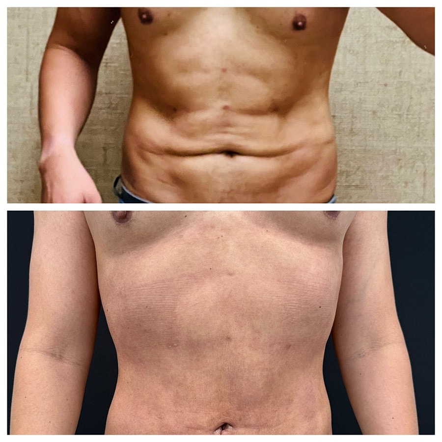 Before and After Revision Liposuction Performed by Dr. Emmanuel De La Cruz