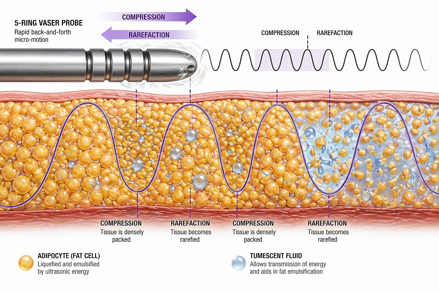 VASER probe illustration showing fat emulsification process.