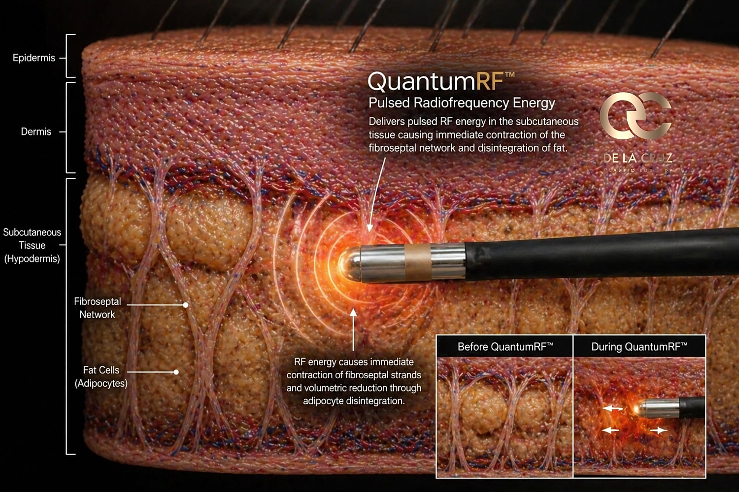 Diagram illustrating QuantumRF pulsed radiofrequency energy.