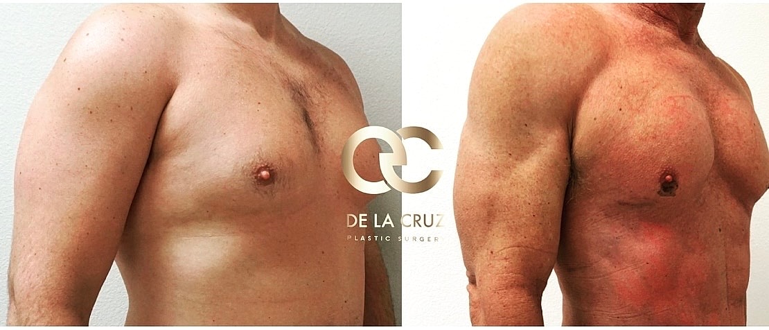 Before and after photo of chest surgery.