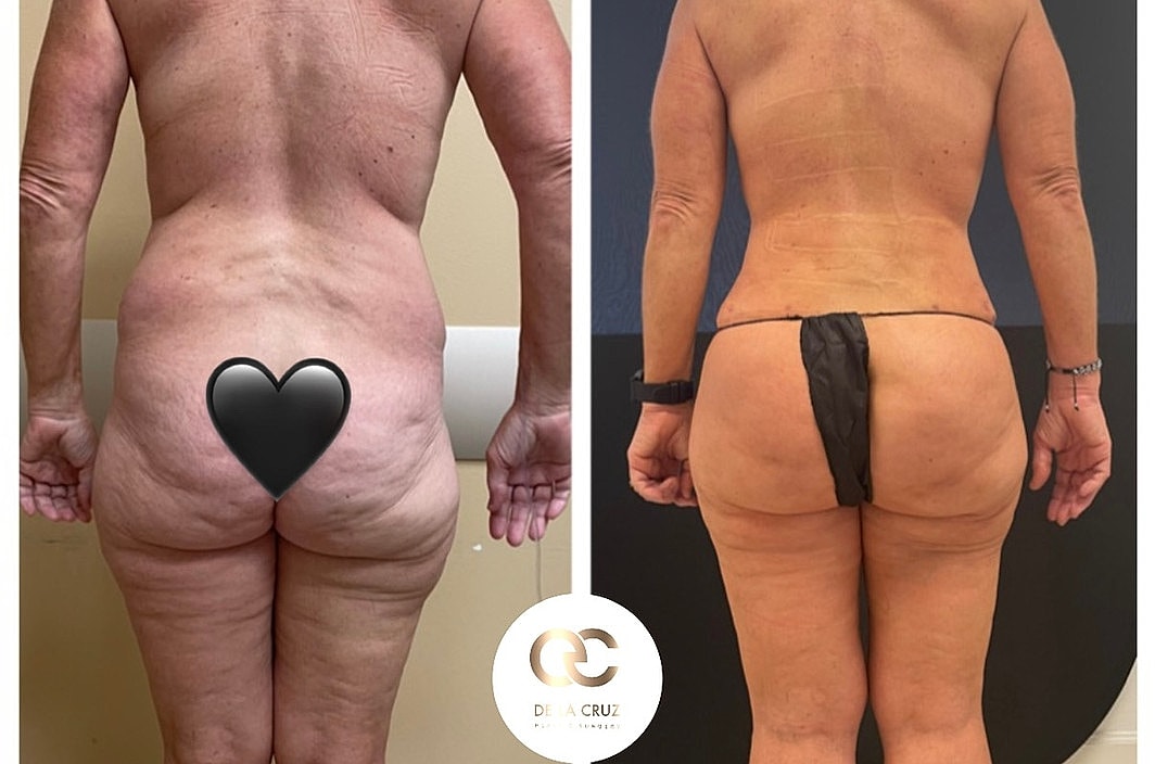 Before and after body treatment comparison.