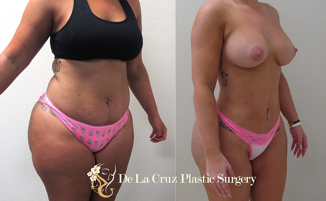 Before and after plastic surgery transformation photo.