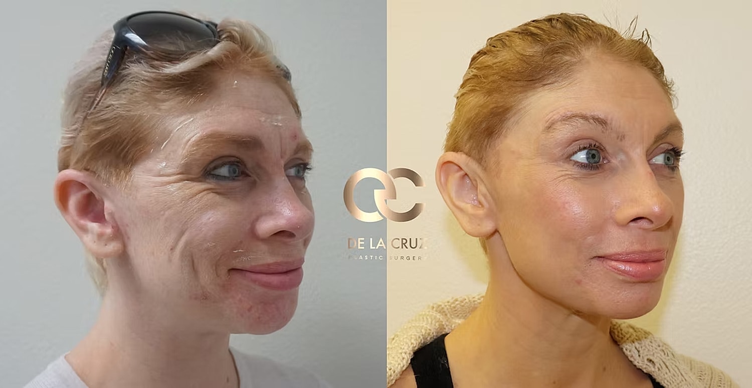 sculptra treatment face.png