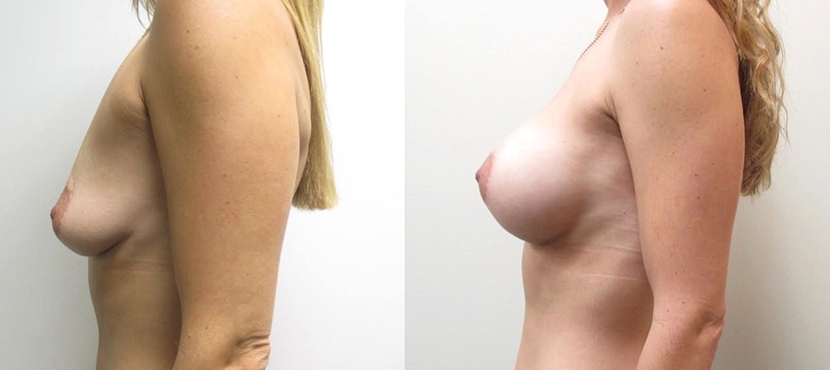 Breast Augmentation Before & After