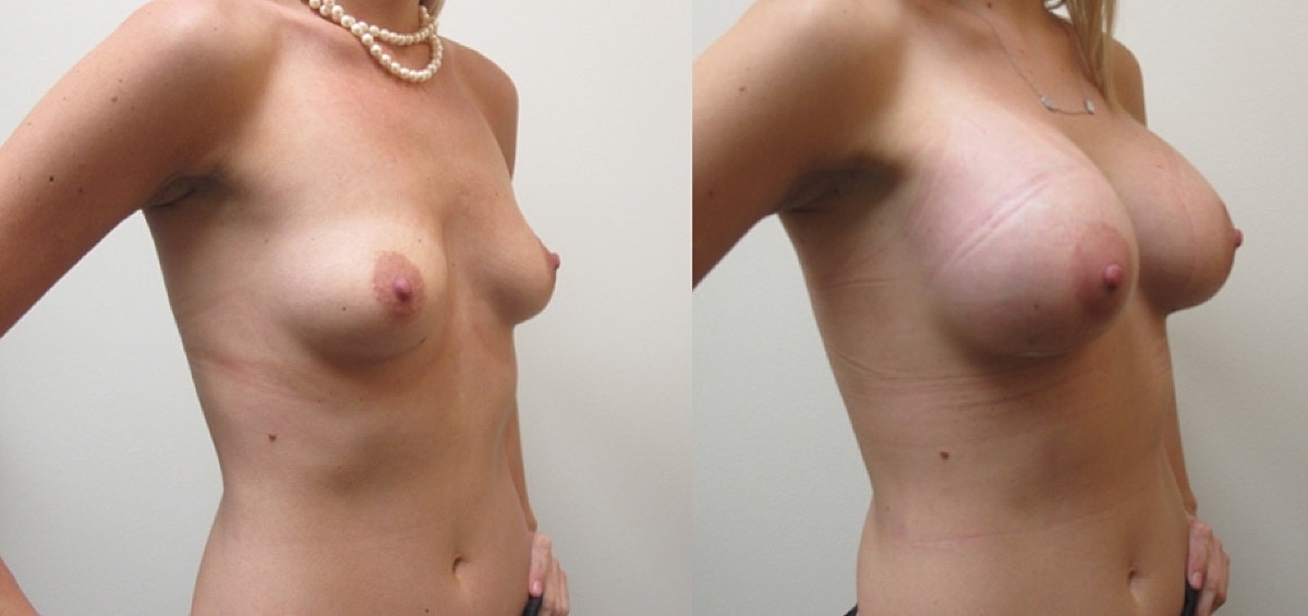 Breast Augmentation Before & After