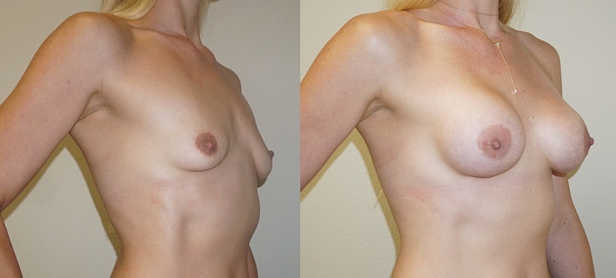 Breast Augmentation Before & After