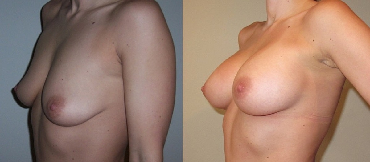 Breast Augmentation Before & After