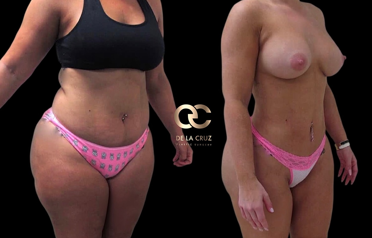 Before and after Lipo360 in a woman