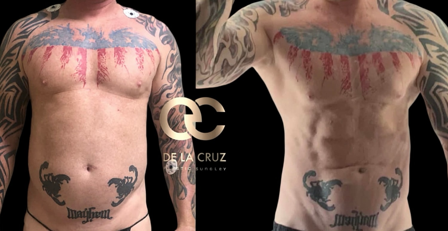 Before and after high-definition liposuction in men with abdominal etching