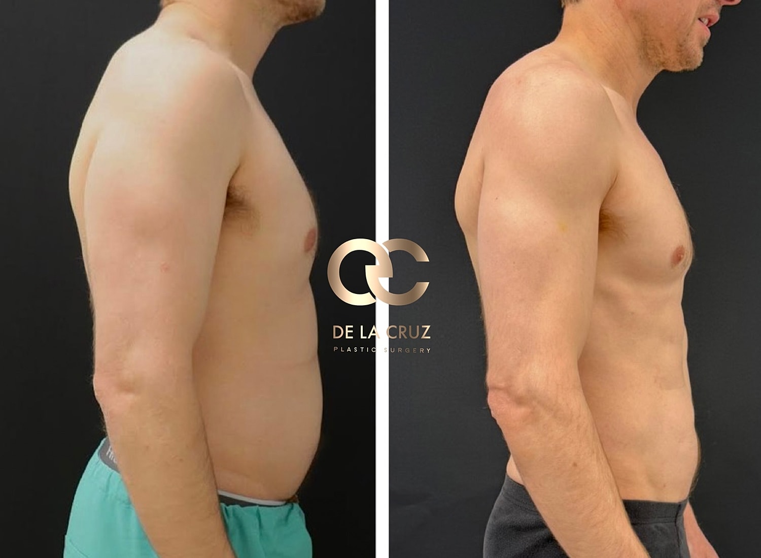 Before and after results high-definition liposuction of the arm in men