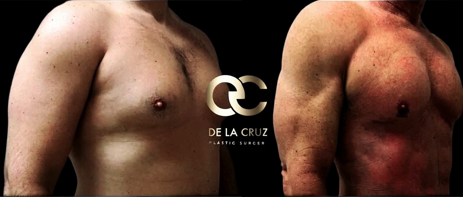 Before and after Liposuction of the arm