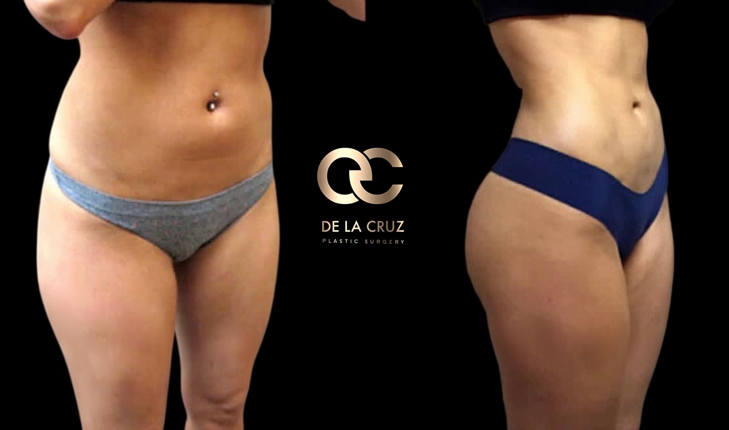 Before and after high definition liposuction in women