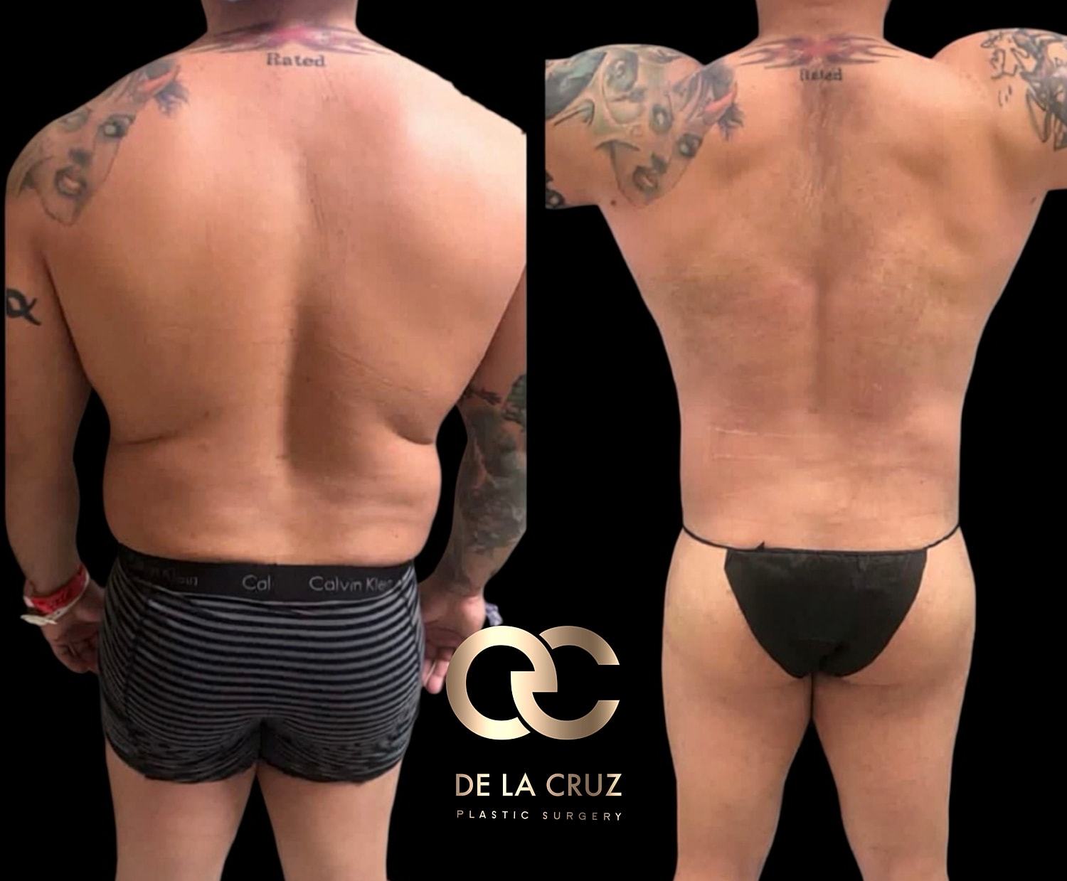 Before and after High-definition liposuction of the back in Men