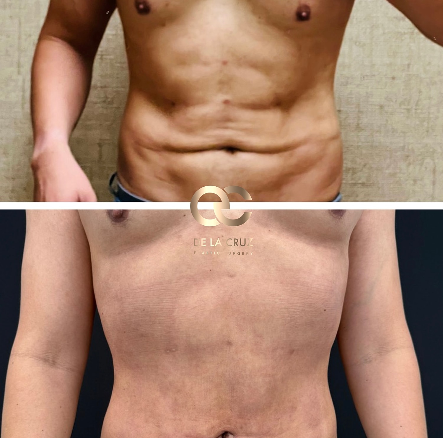 Before and after Revision liposuction with correction of contour irregularities