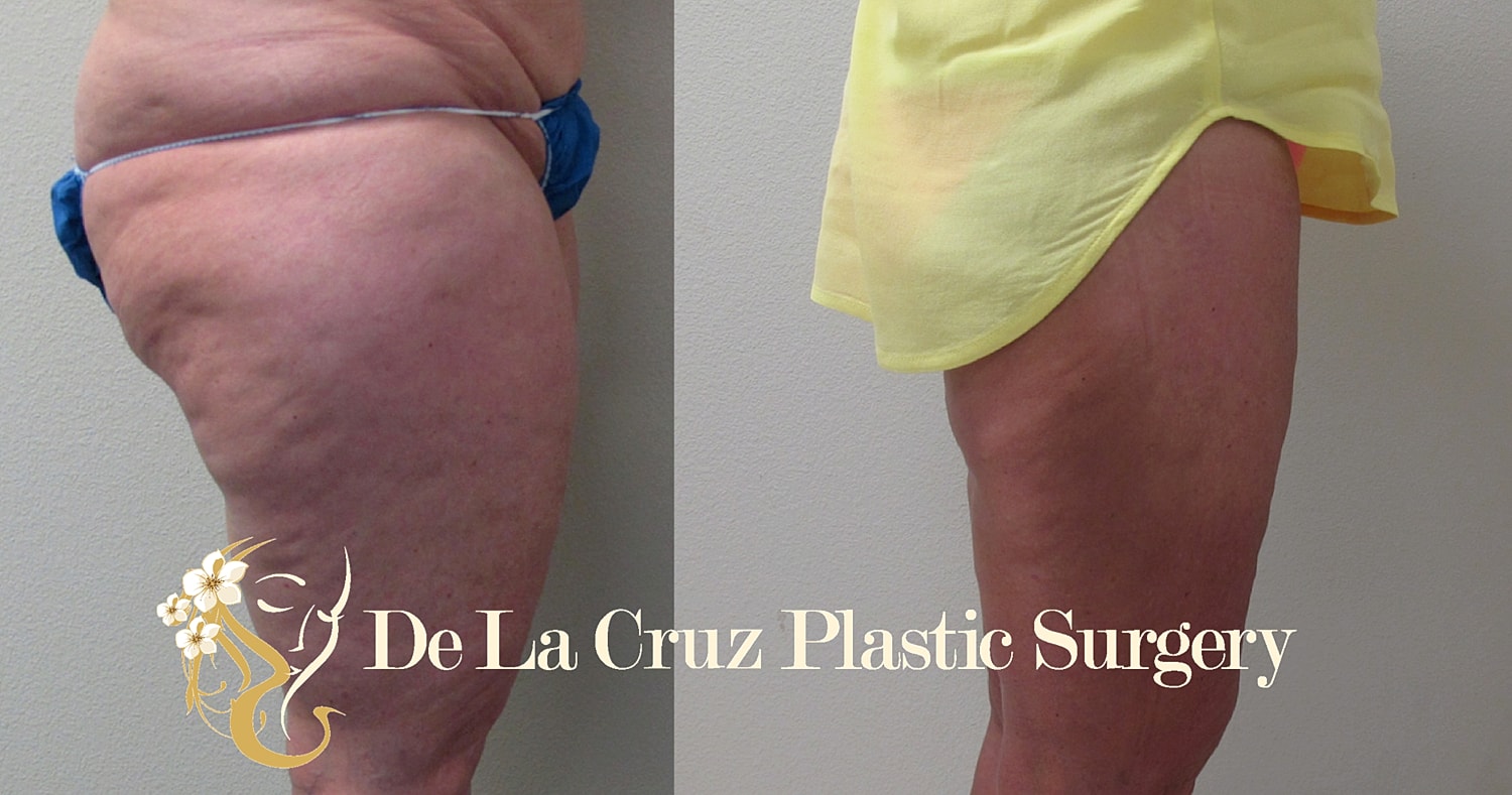 Before and after Liposuction of the thighs