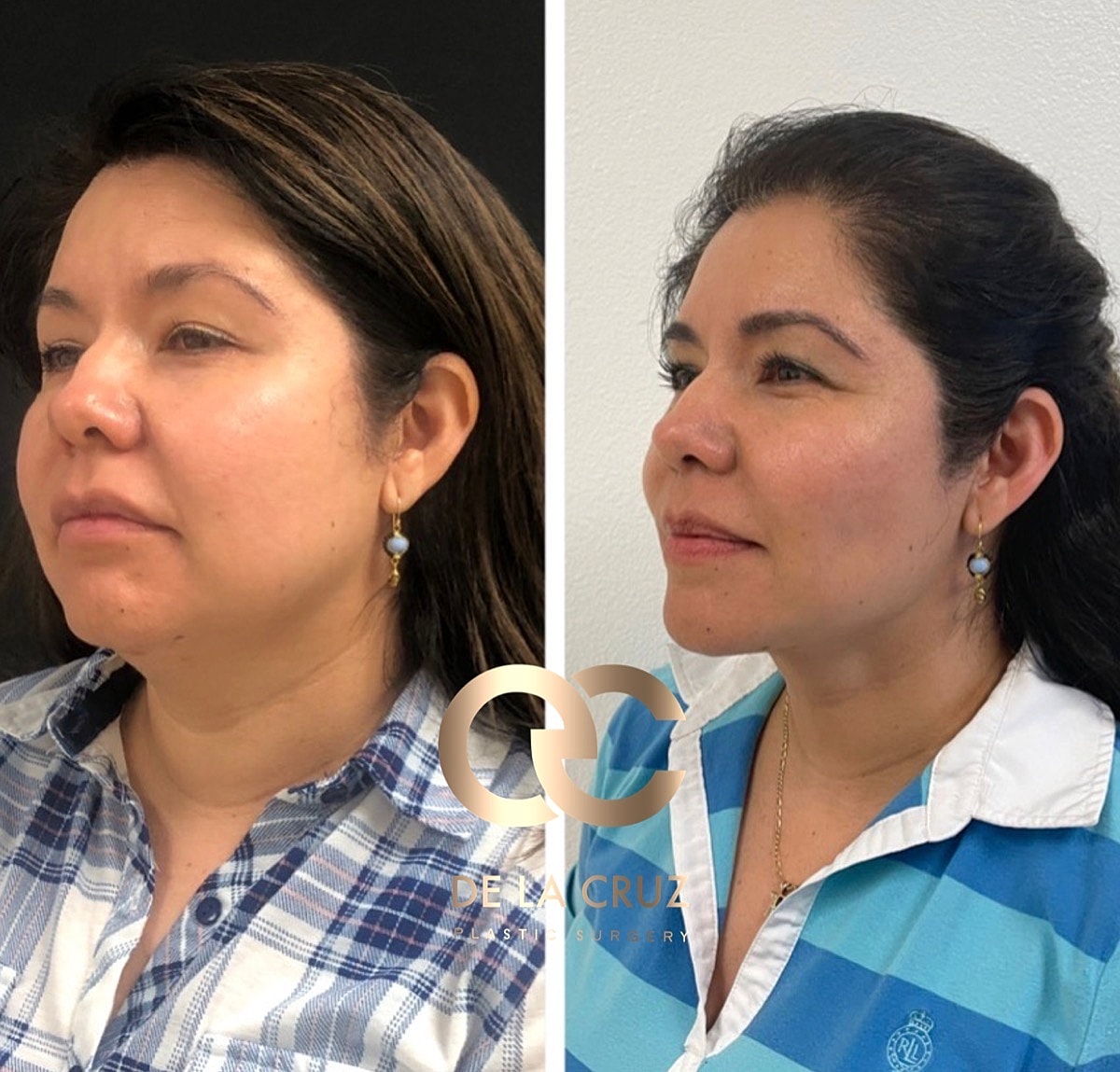 Necktite Before & After