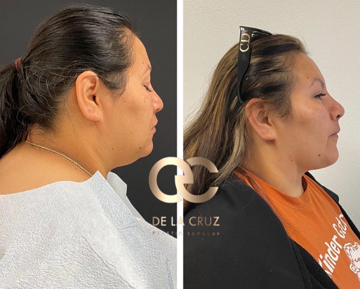 Necktite Before & After