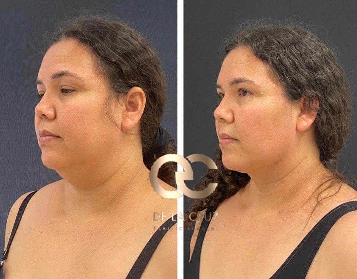 Necktite Before & After