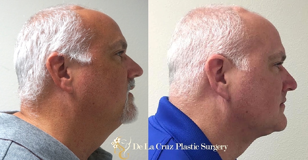 Neck Lift Before & After